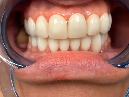 The same teeth after Hollywood Smile veneers at Burlington Dental Centre