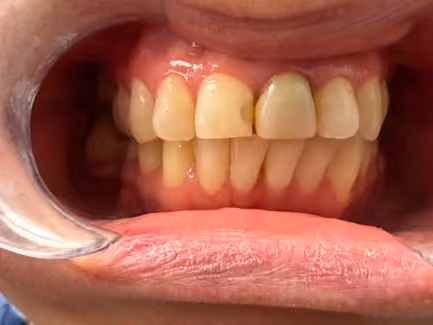 Teeth before Hollywood Smile treatment at Burlington Dental Centre