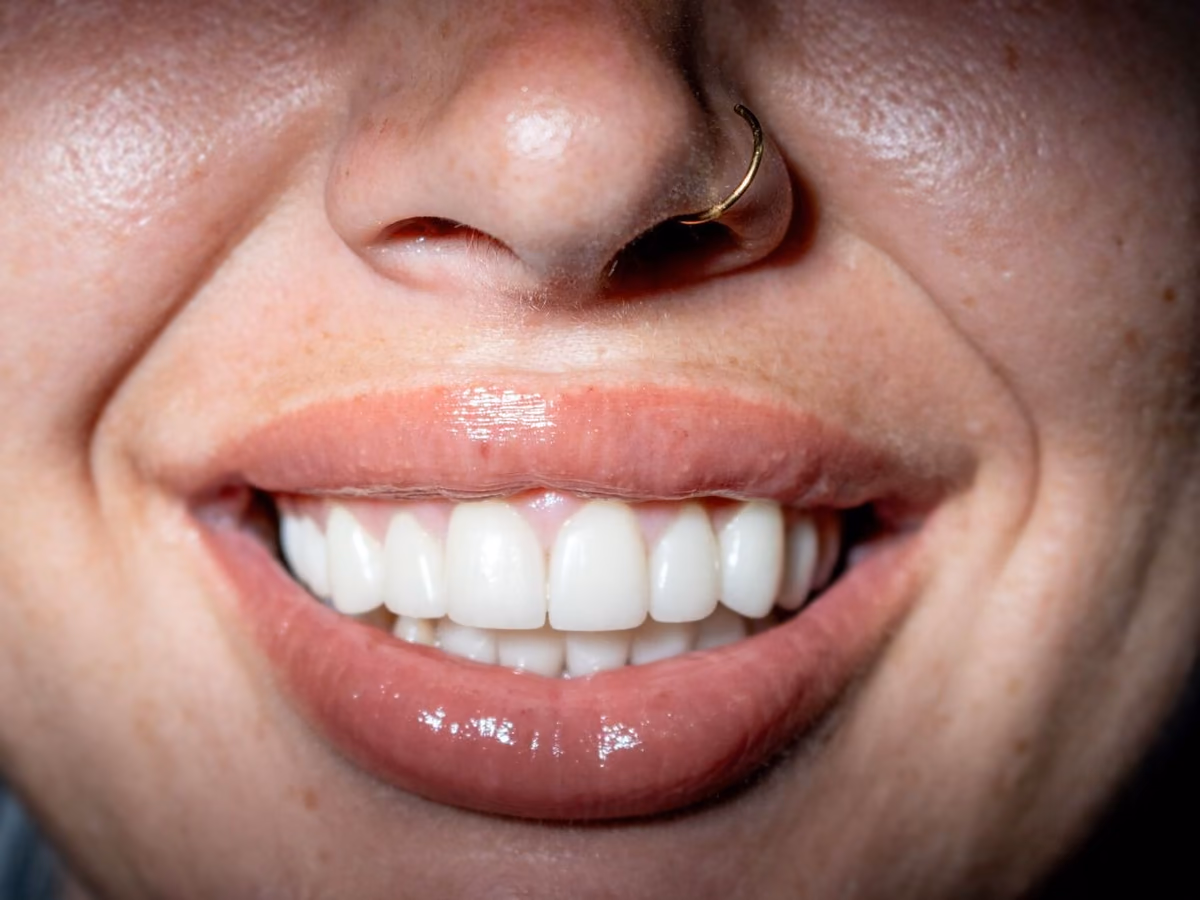 A bright, even smile after Hollywood Smile veneers at Burlington Dental Centre