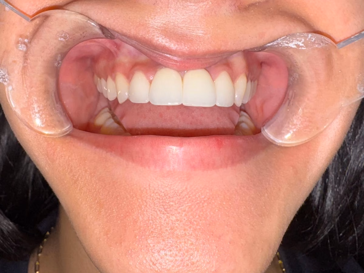 The same upper teeth after Hollywood Smile veneers at Burlington Dental Centre
