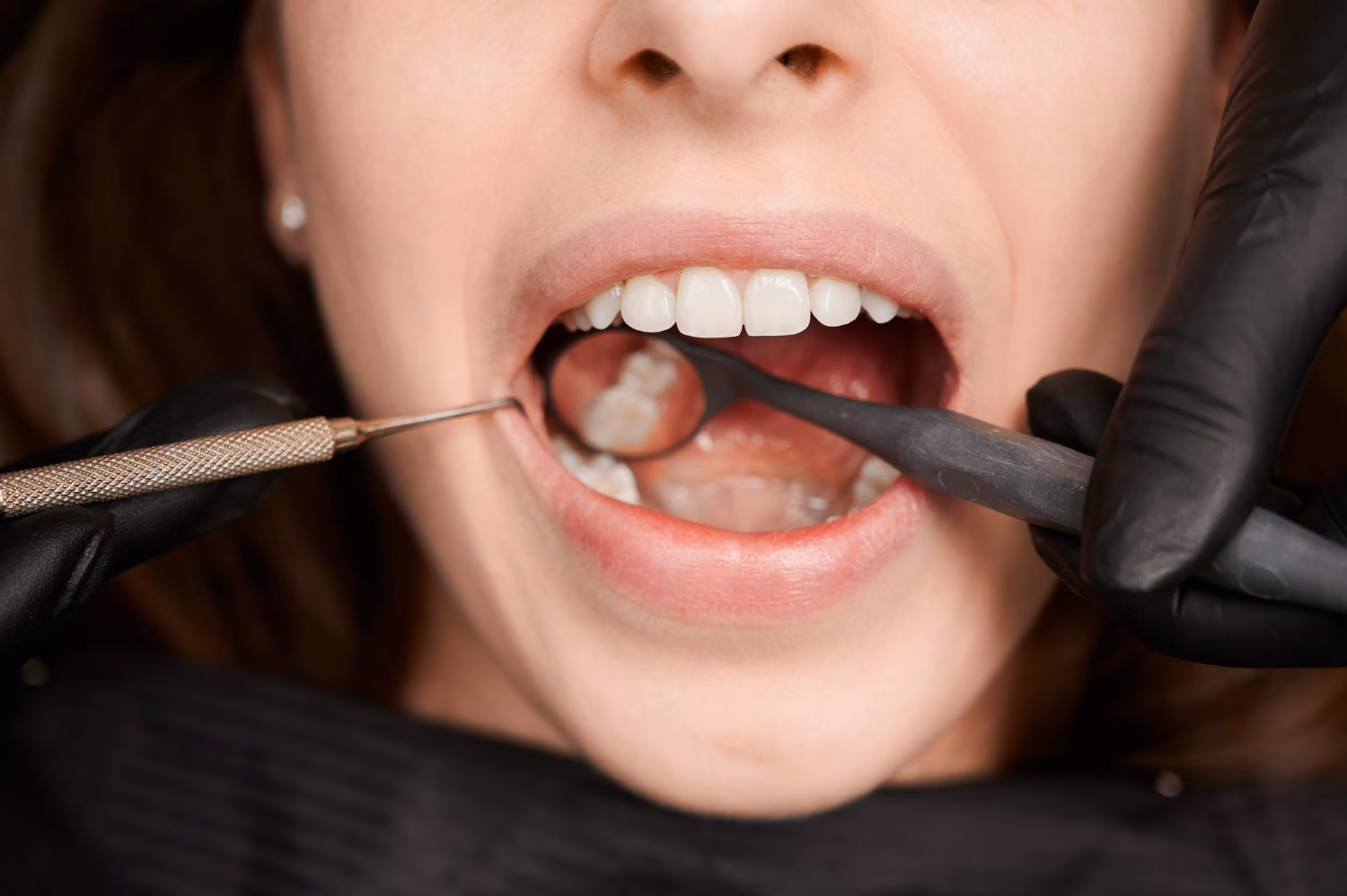 Dental implants treatment in Burlington
